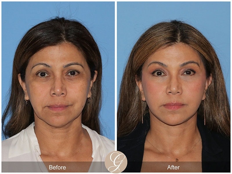 Deep Plane Facelift Before & After Photo