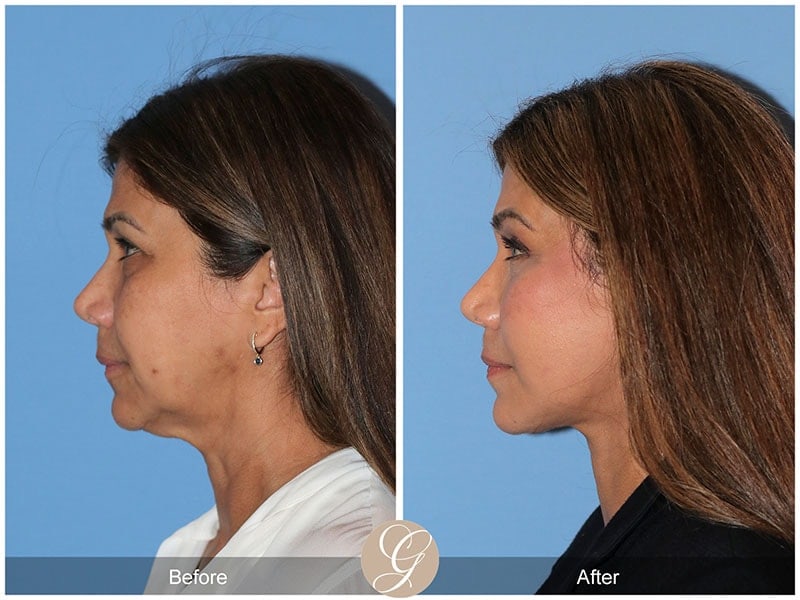 Deep Plane Facelift Before & After Photo