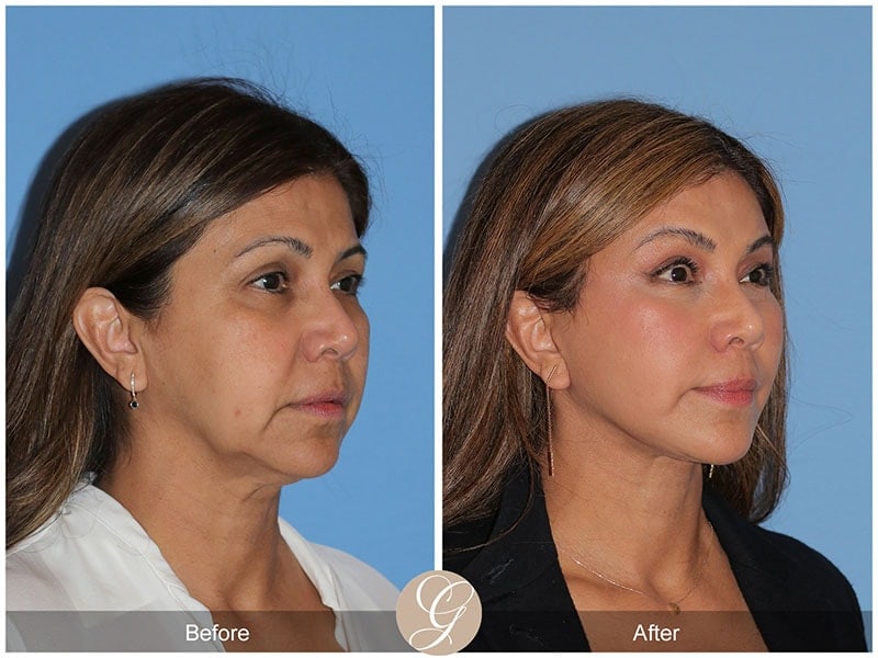 Deep Plane Facelift Before & After Photo