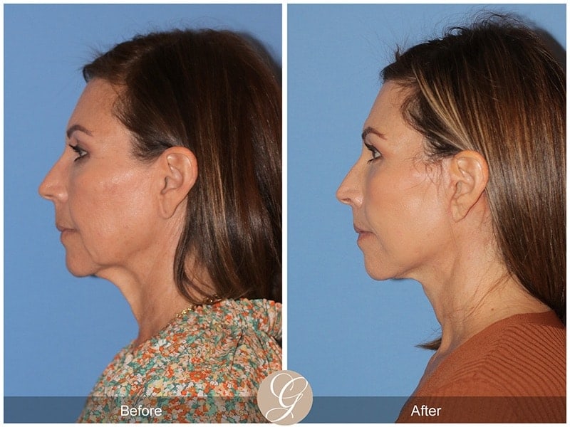 Deep Plane Facelift Before & After Photo