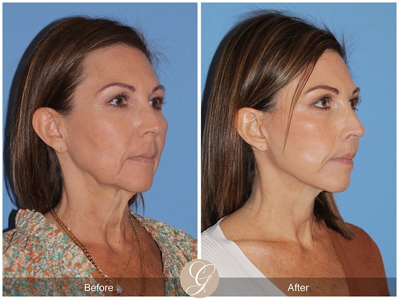 Deep Plane Facelift Before & After Photo