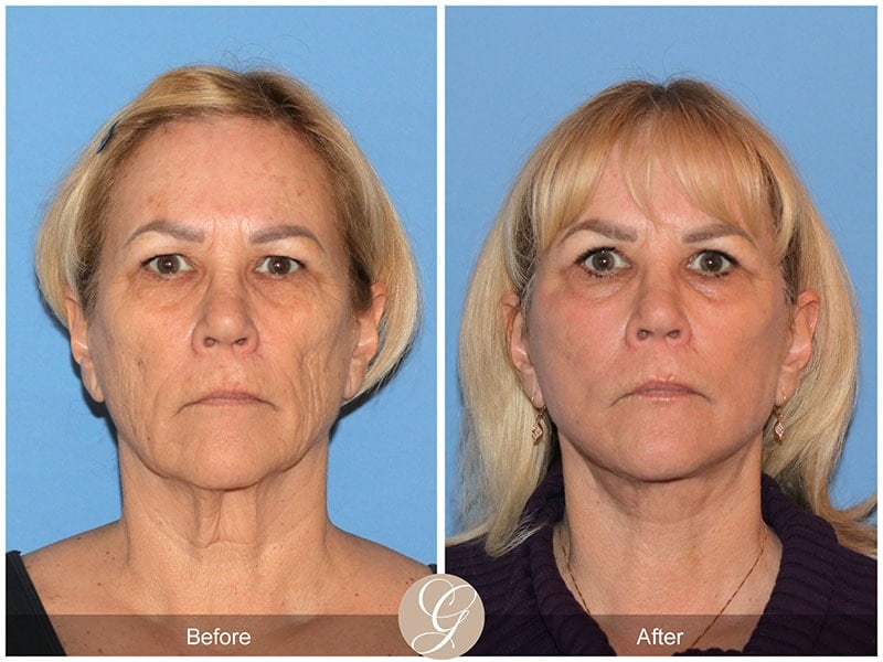 Deep Plane Facelift Before & After Photo