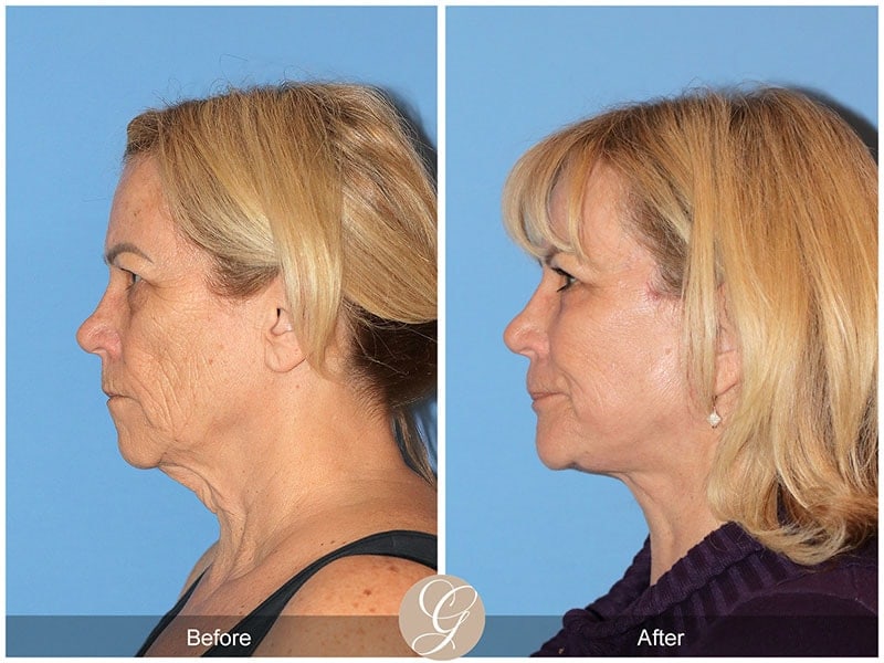 Deep Plane Facelift Before & After Photo