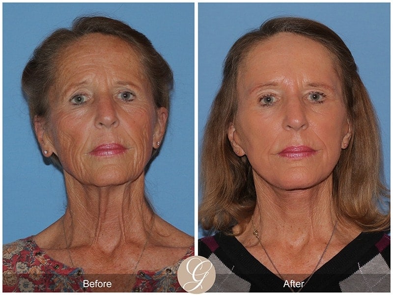 Deep Plane Facelift Before & After Photo