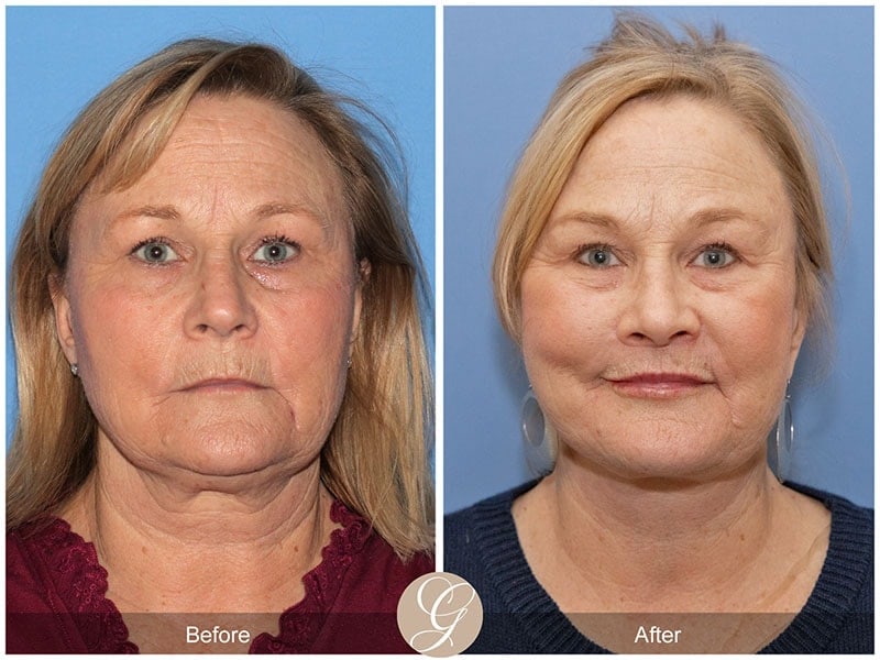 Deep Plane Facelift Before & After Photo