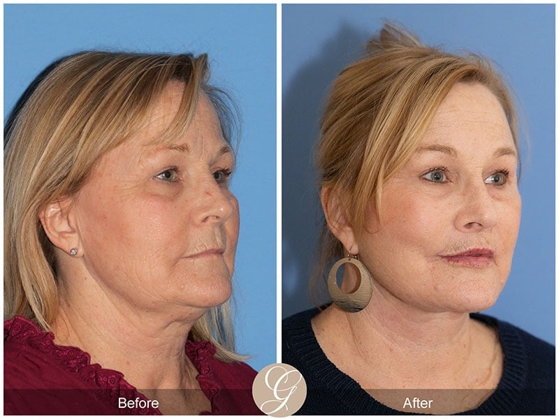 Deep Plane Facelift Before & After Photo