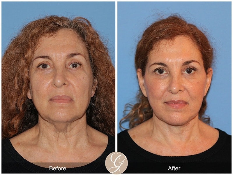 Deep Plane Facelift Before & After Photo