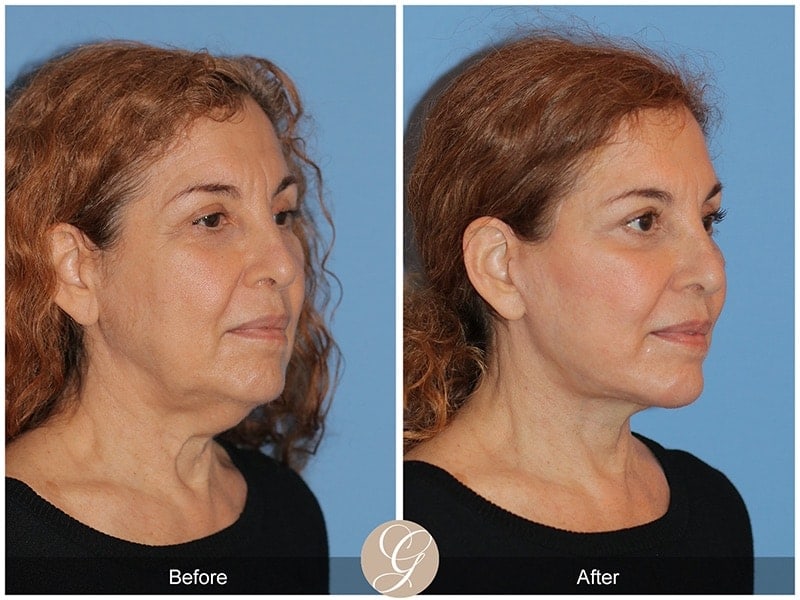 Deep Plane Facelift Before & After Photo