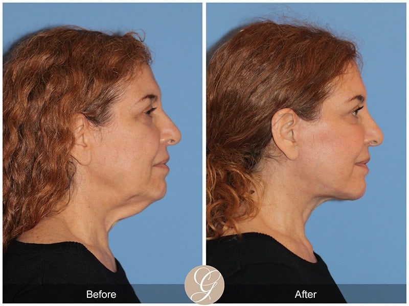 Deep Plane Facelift Before & After Photo