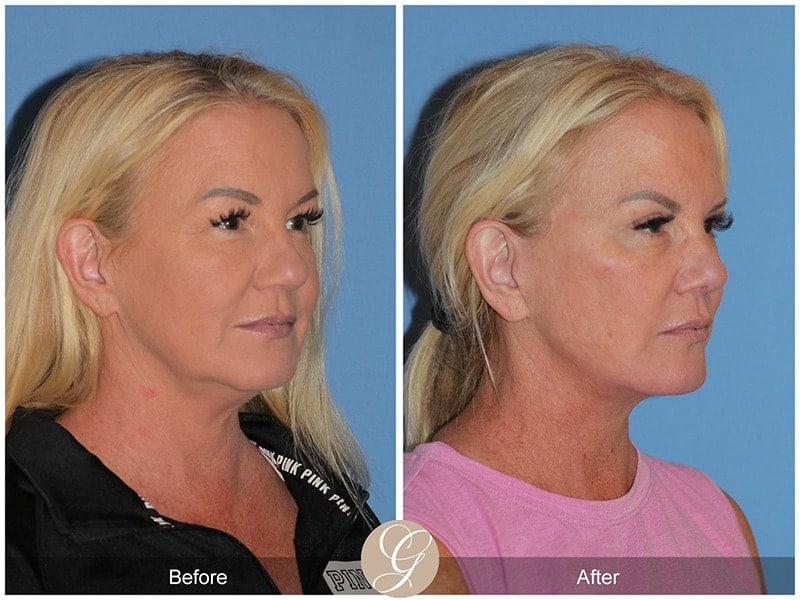 Deep Plane Facelift Before & After Photo