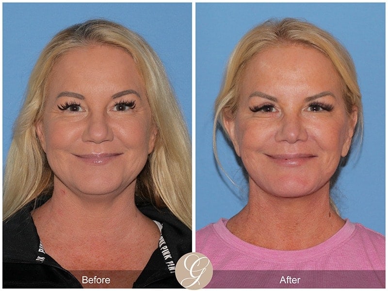 Deep Plane Facelift Before & After Photo