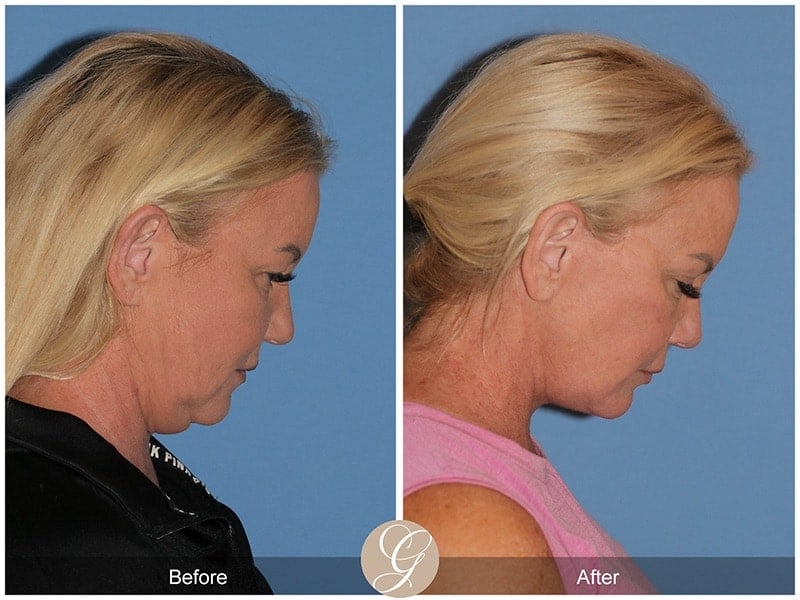 Deep Plane Facelift Before & After Photo