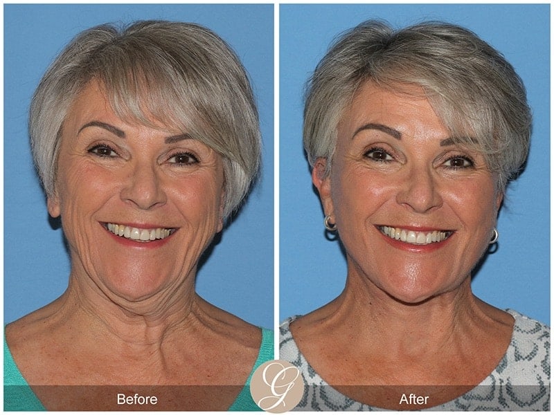 Deep Plane Facelift Before & After Photo