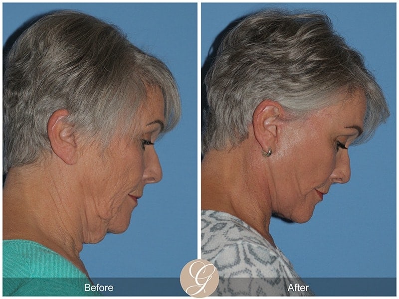 Deep Plane Facelift Before & After Photo