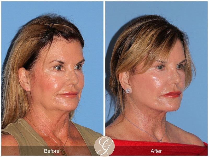 Deep Plane Facelift Before & After Photo