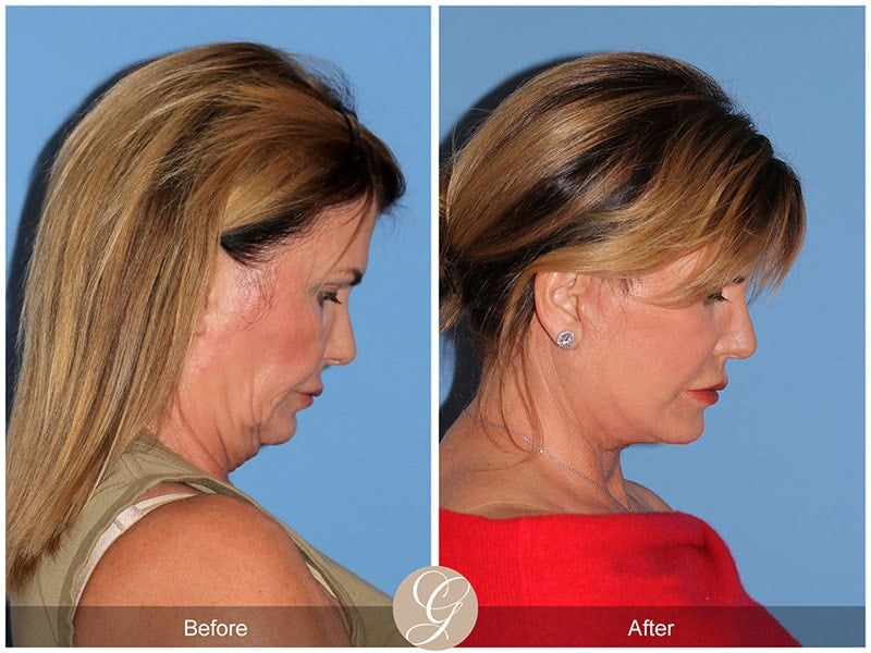 Deep Plane Facelift Before & After Photo