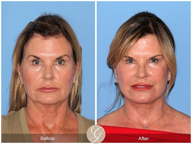 Deep Plane Facelift Before & After Photo