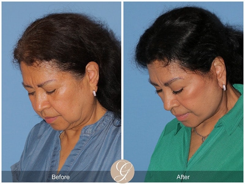 Deep Plane Facelift Before & After Photo