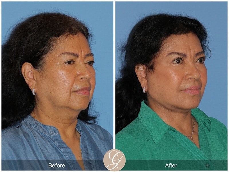 Deep Plane Facelift Before & After Photo