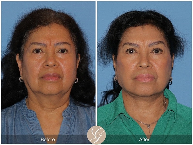 Deep Plane Facelift Before & After Photo