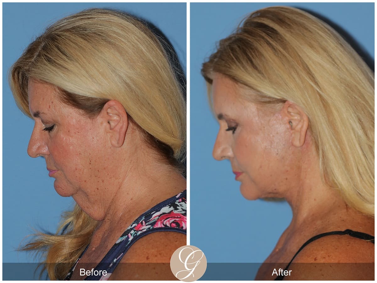 Deep Plane Facelift Before & After Photo