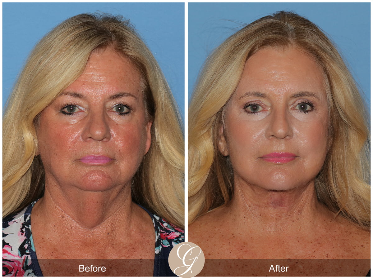 Deep Plane Facelift Before & After Photo