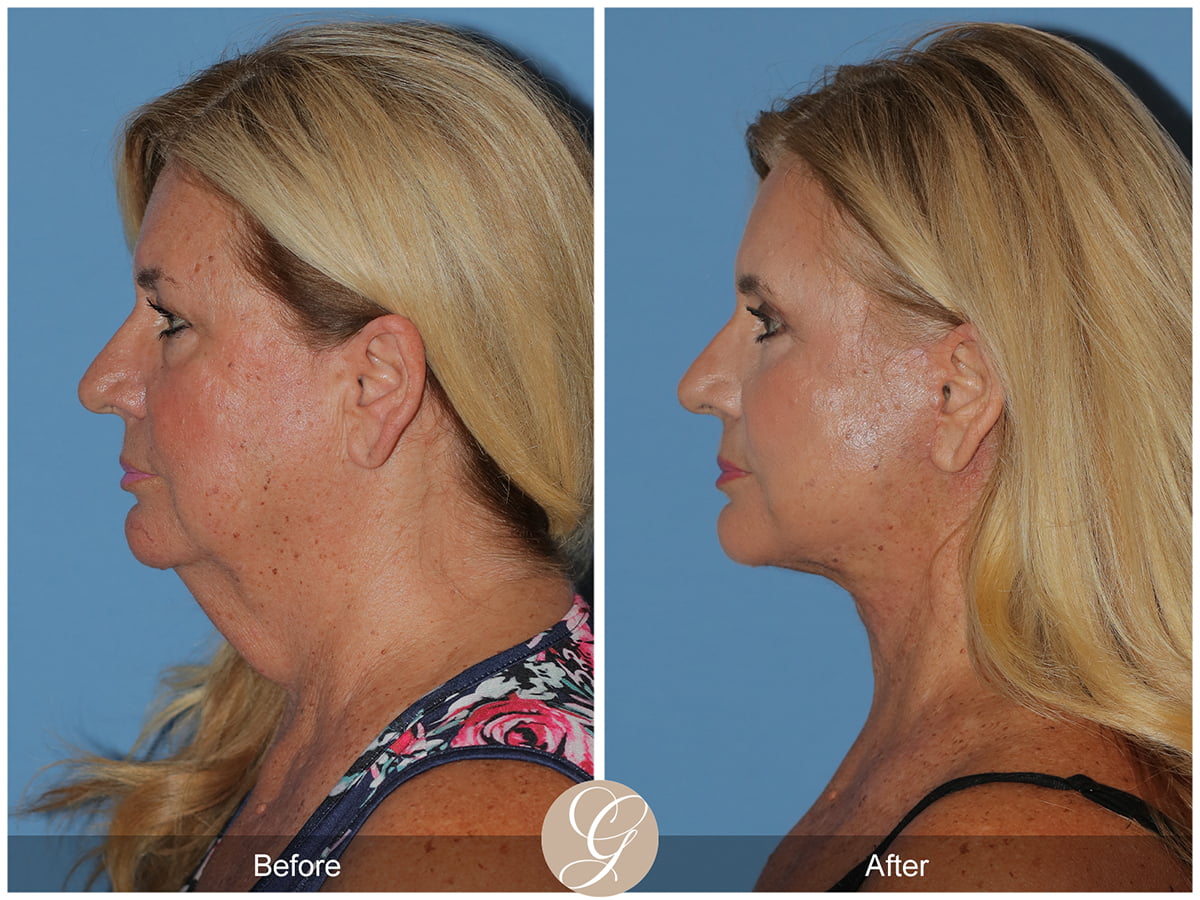 Deep Plane Facelift Before & After Photo