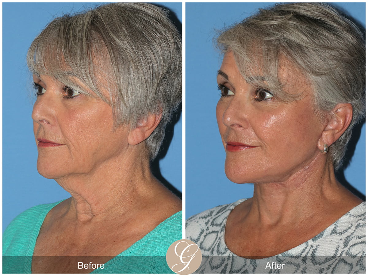 Deep Plane Facelift Before & After Photo