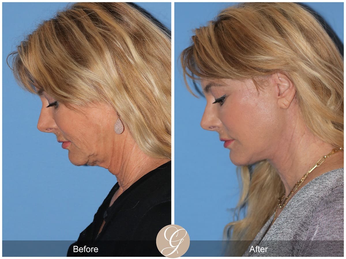 Deep Plane Facelift Before & After Photo