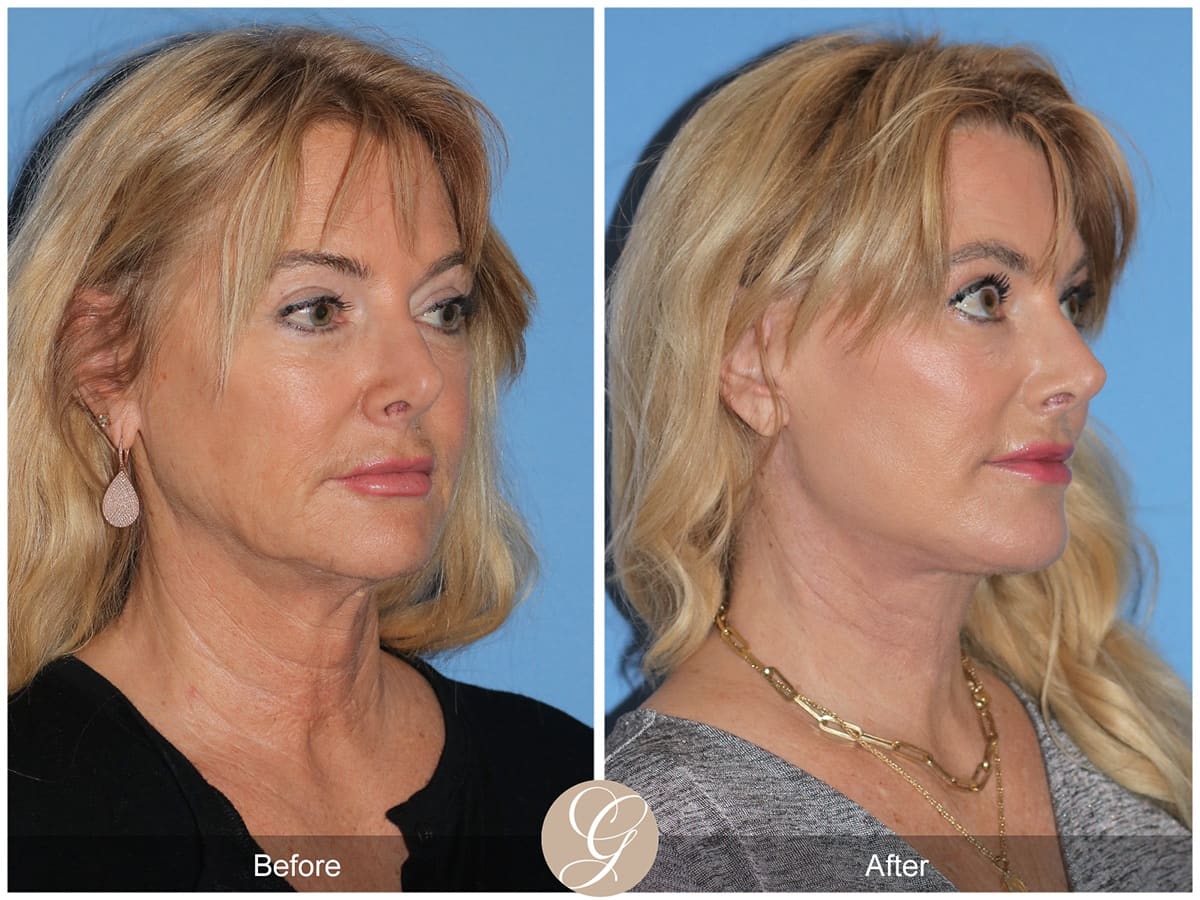 Deep Plane Facelift Before & After Photo