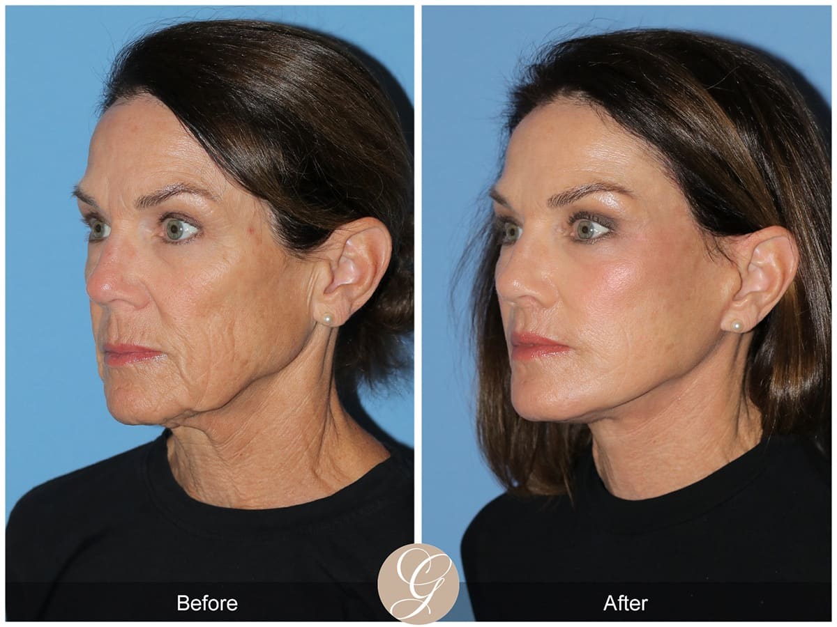 Deep Plane Facelift Before & After Photo