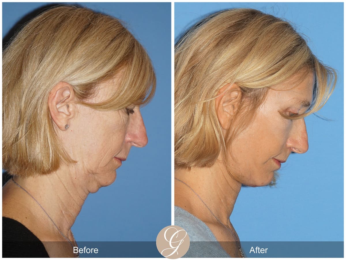 Deep Plane Facelift Before & After Photo