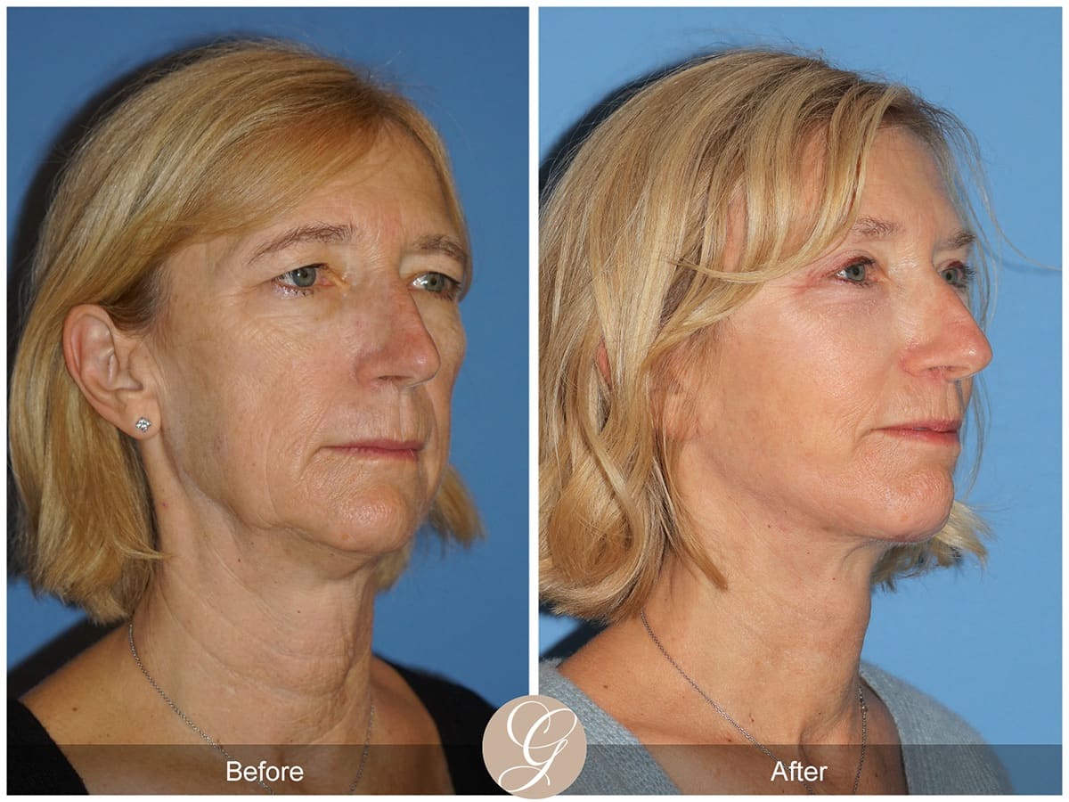 Deep Plane Facelift Before & After Photo