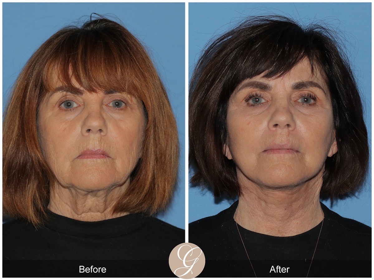 Deep Plane Facelift Before & After Photo