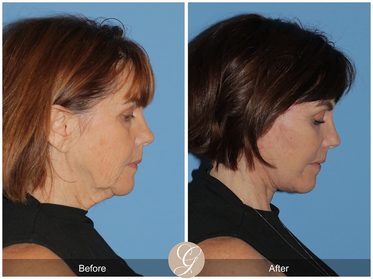 Deep Plane Facelift Before & After Photo