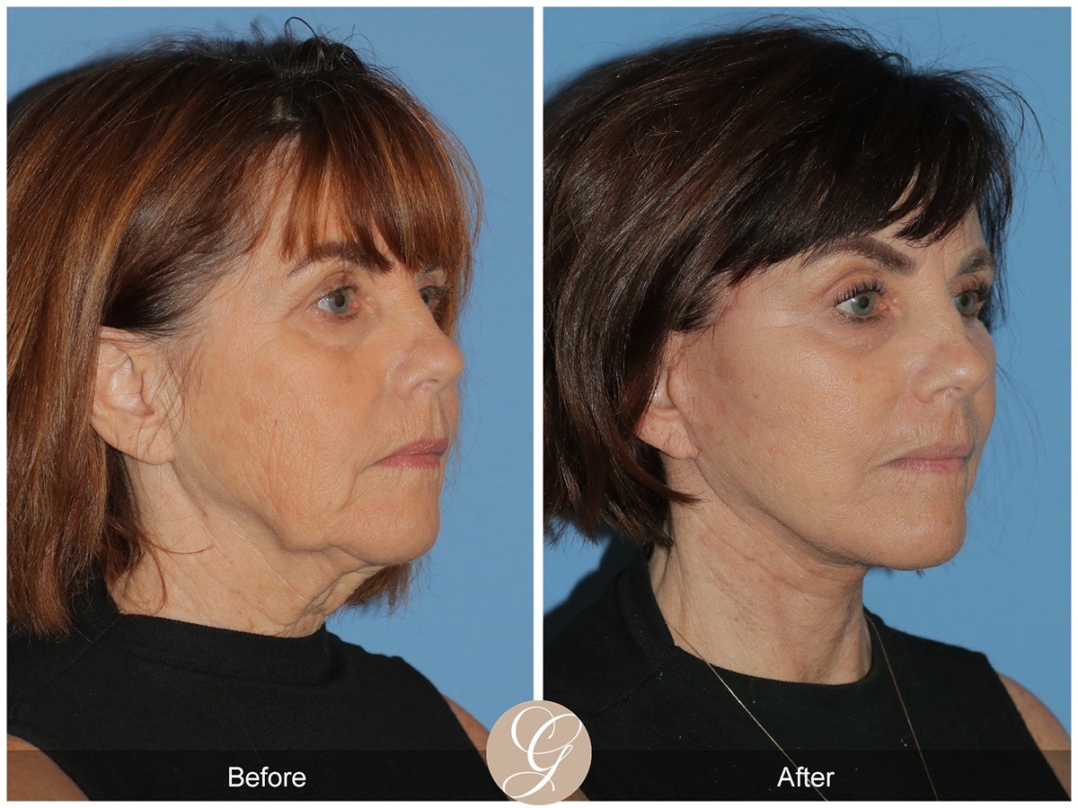 Deep Plane Facelift Before & After Photo