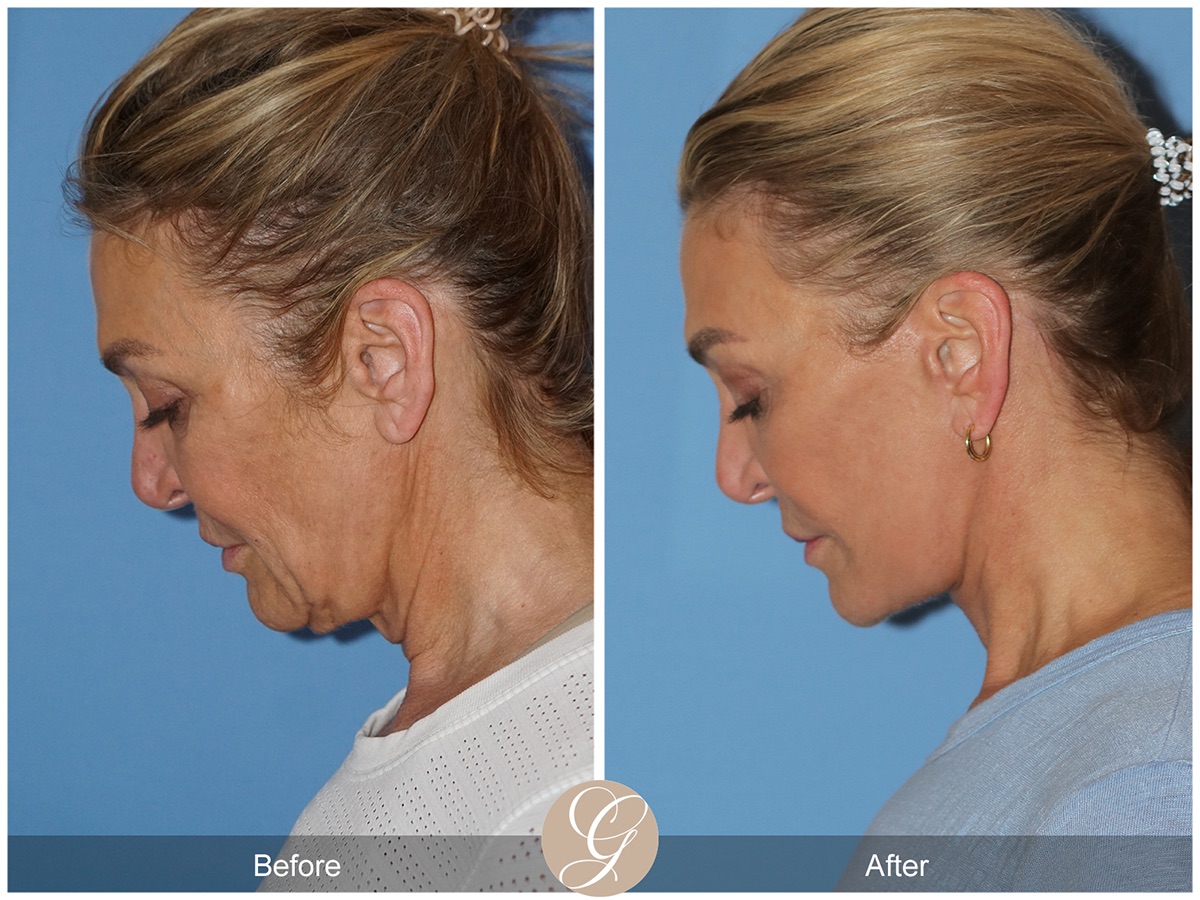 Deep Plane Facelift Before & After Photo