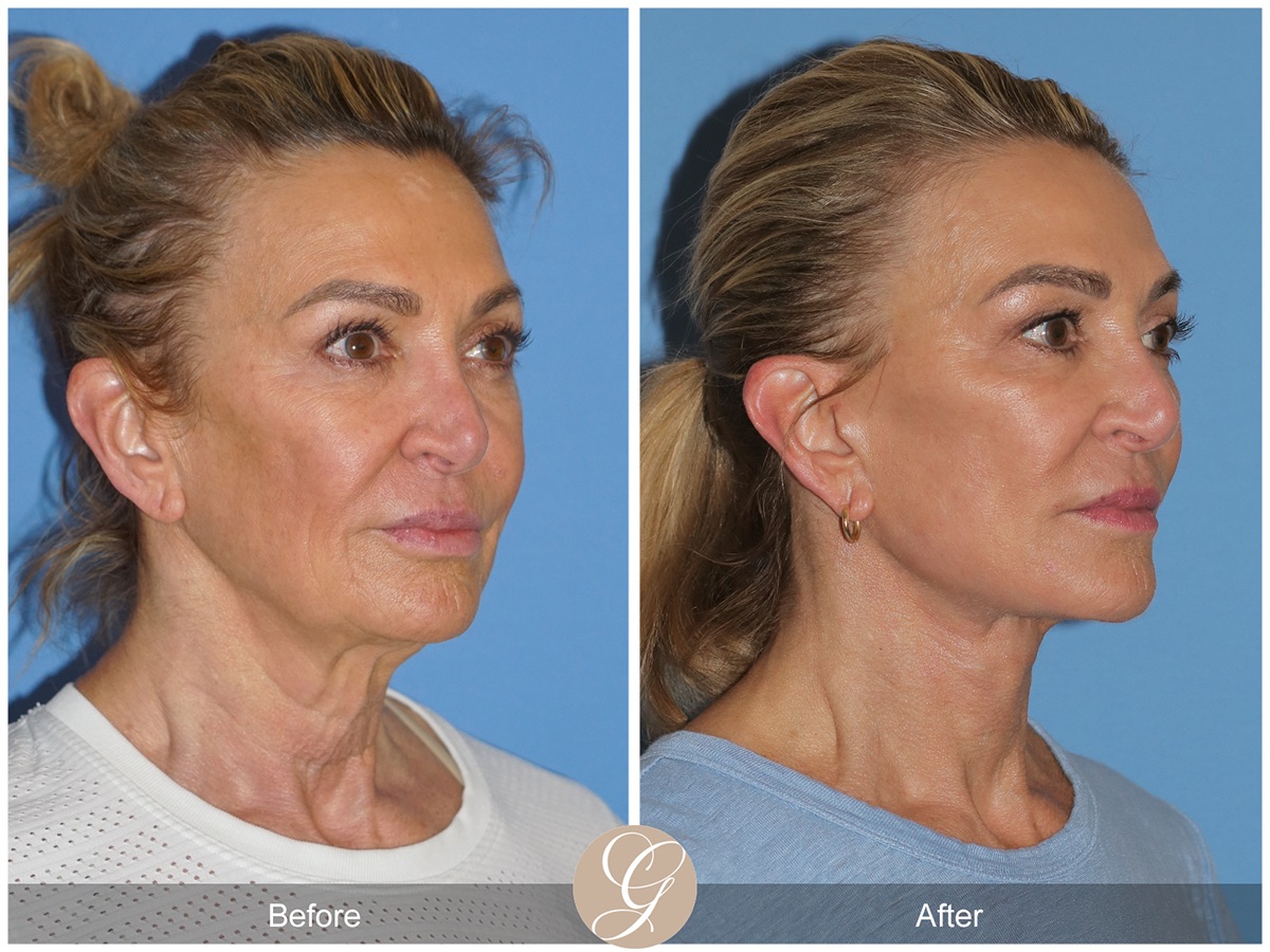 Deep Plane Facelift Before & After Photo