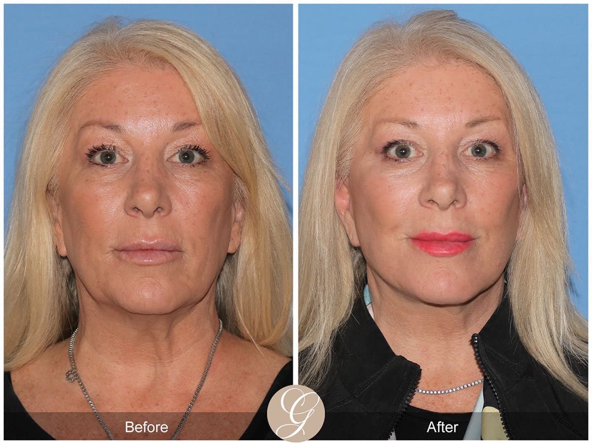 Deep Plane Facelift Before & After Photo