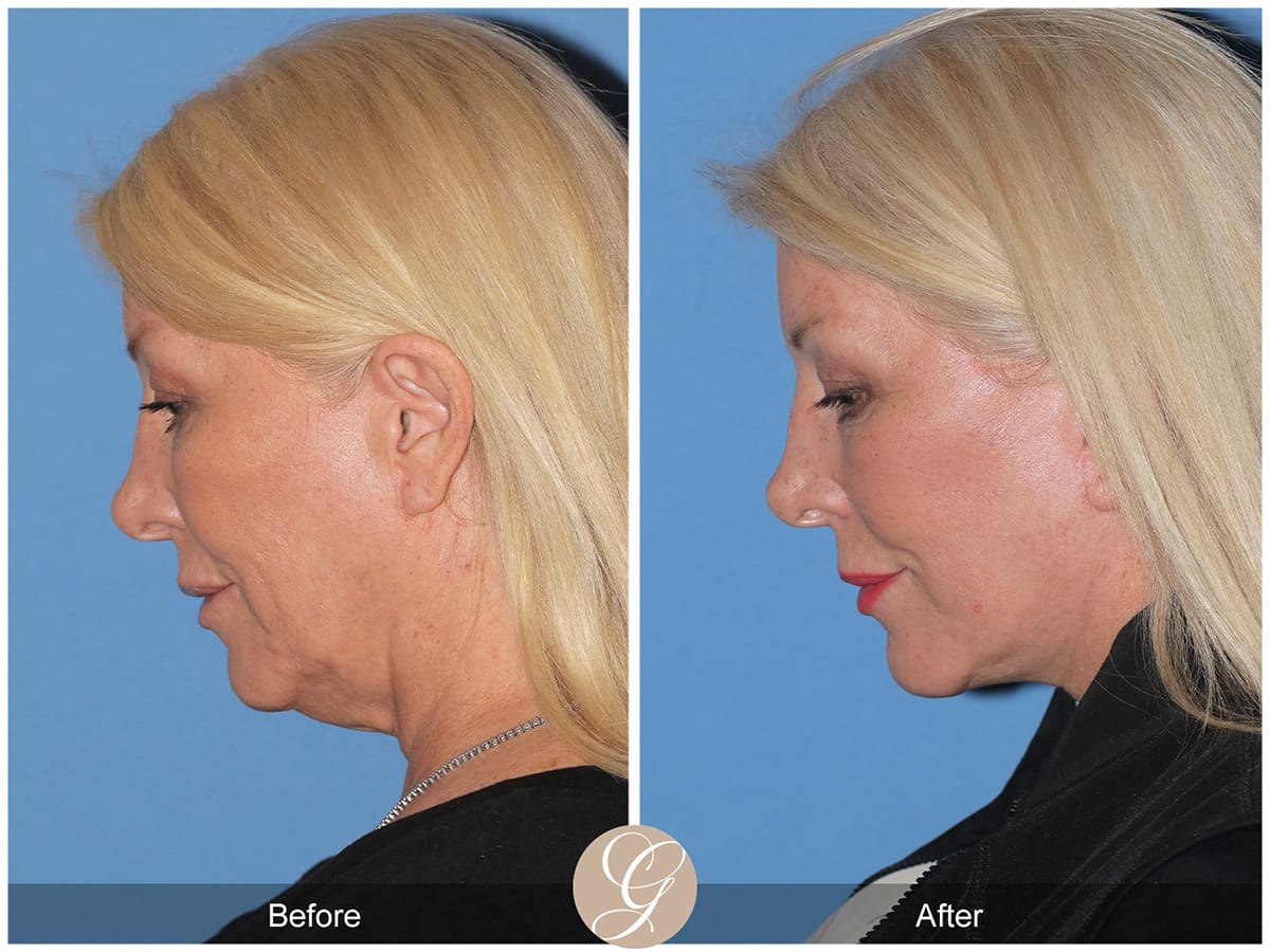 Deep Plane Facelift Before & After Photo