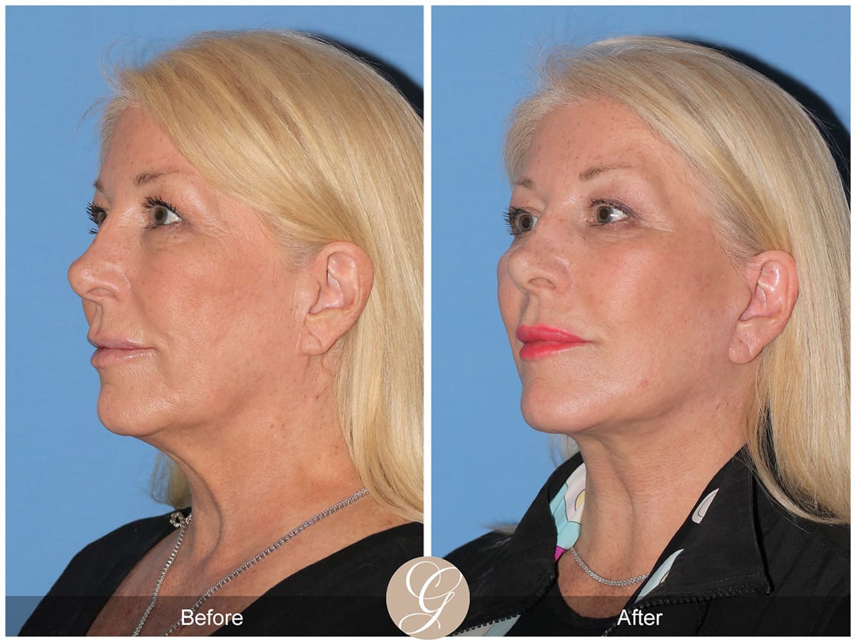 Deep Plane Facelift Before & After Photo