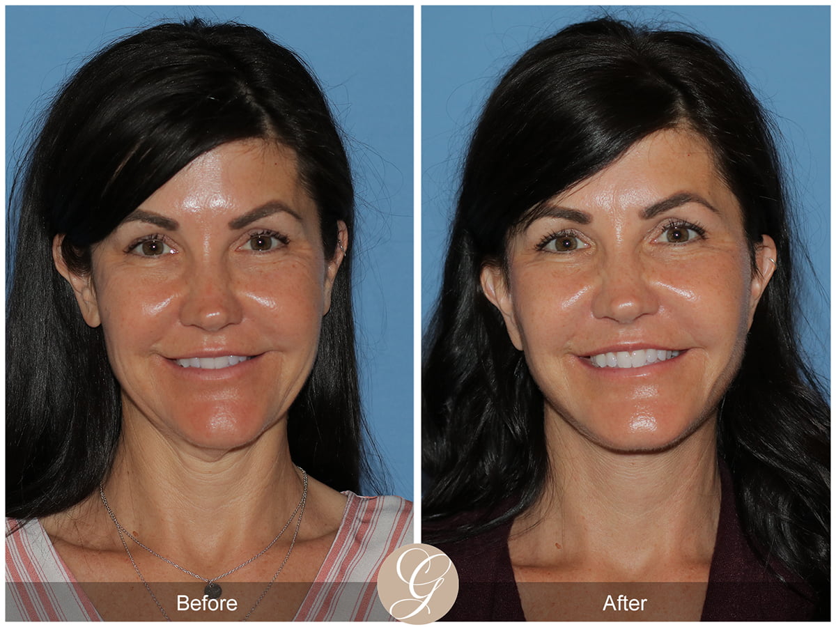 Deep Plane Facelift Before & After Photo