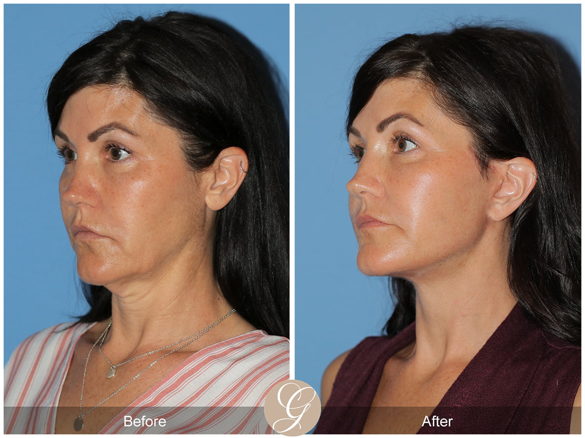 Deep Plane Facelift Before & After Photo