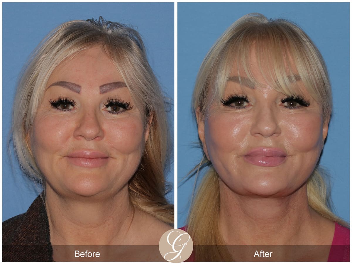 Deep Plane Facelift Before & After Photo