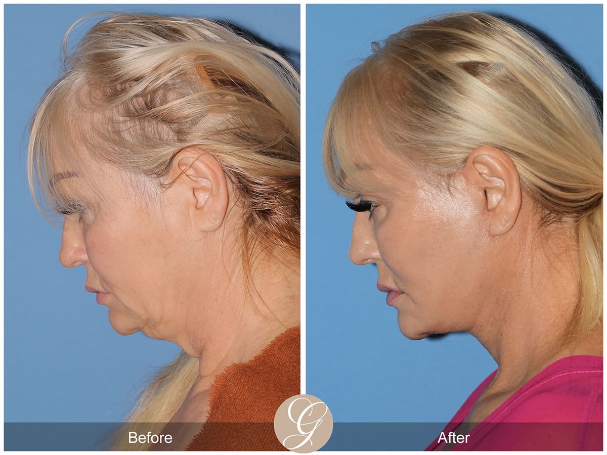 Deep Plane Facelift Before & After Photo