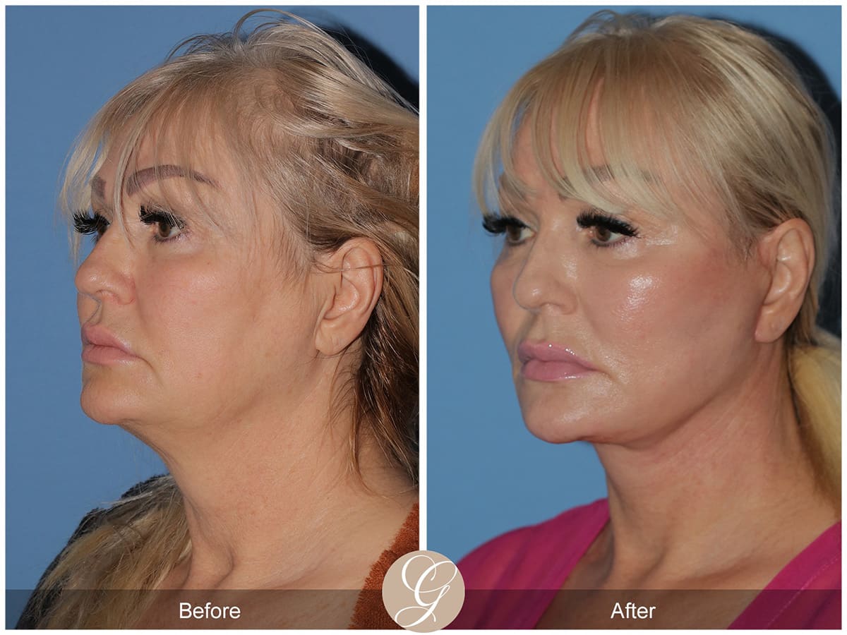 Deep Plane Facelift Before & After Photo