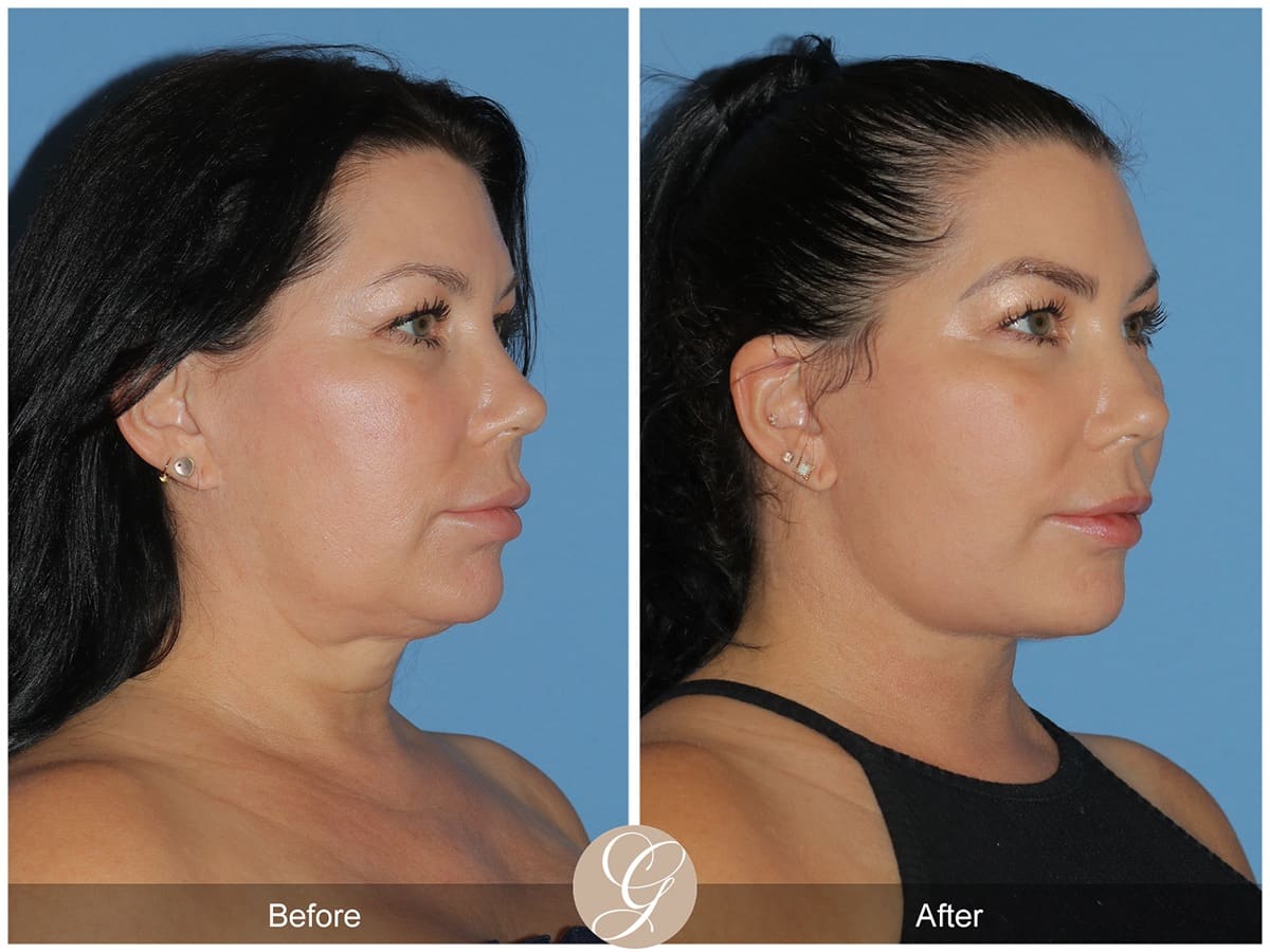 Deep Plane Facelift Before & After Photo