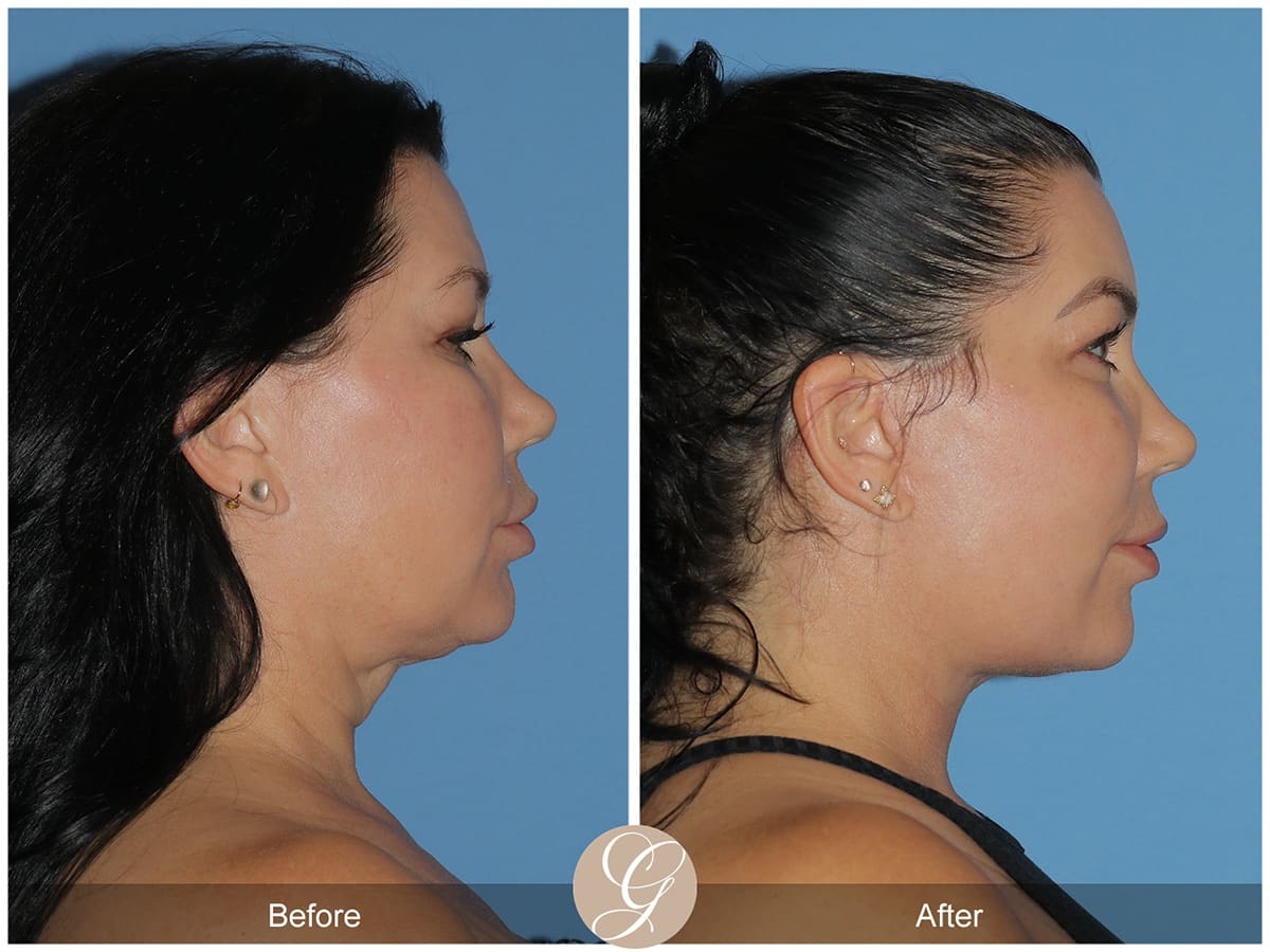 Deep Plane Facelift Before & After Photo