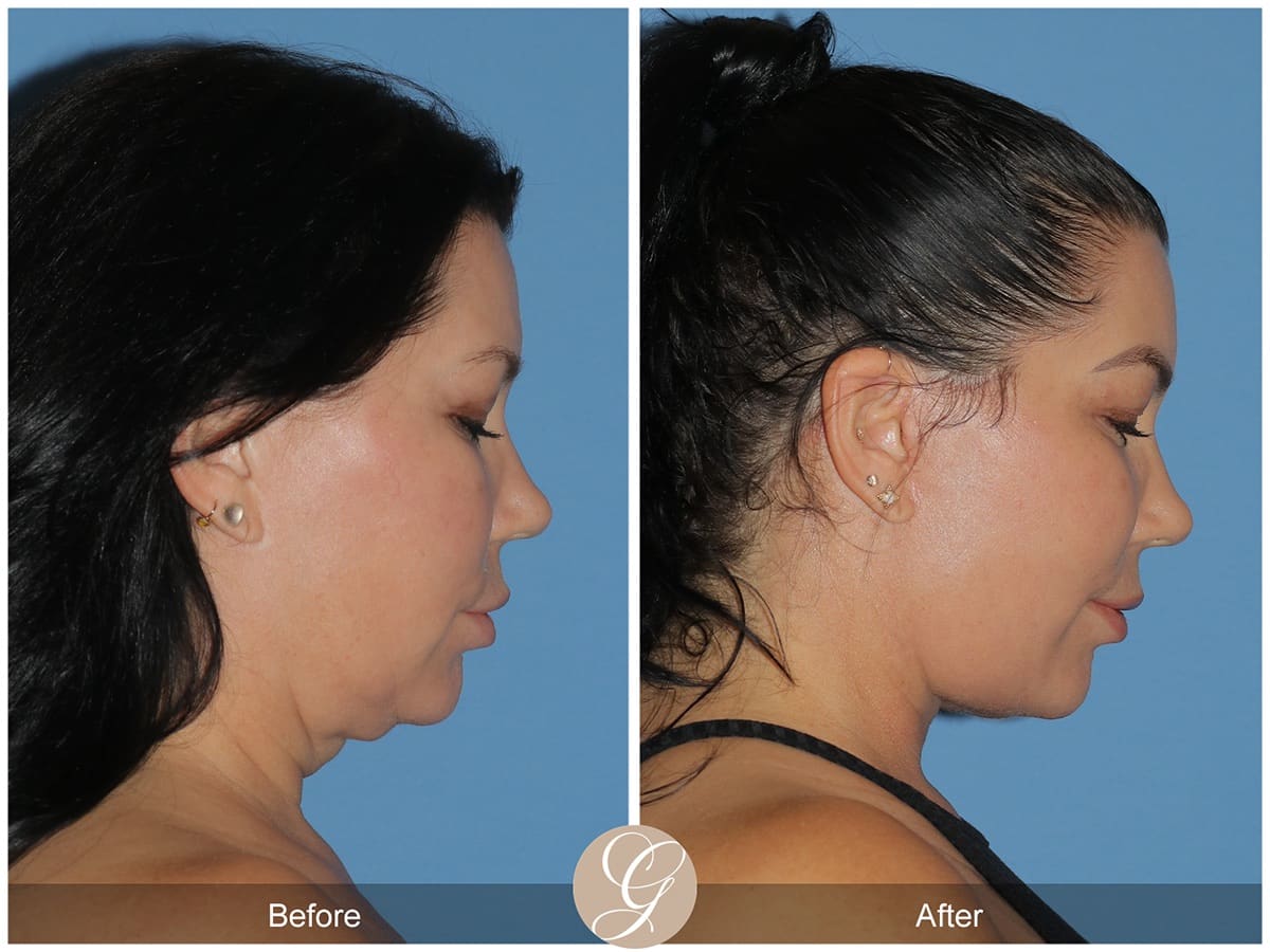 Deep Plane Facelift Before & After Photo