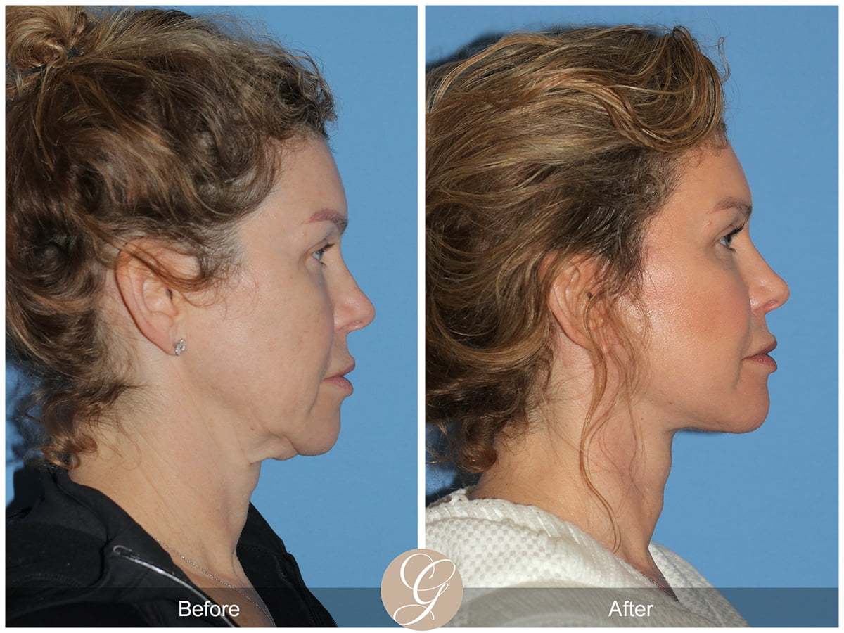 Deep Plane Facelift Before & After Photo